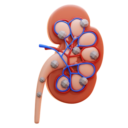 Advanced Kidney Stone Treatment in Salem — 3D Kidney Stone Model