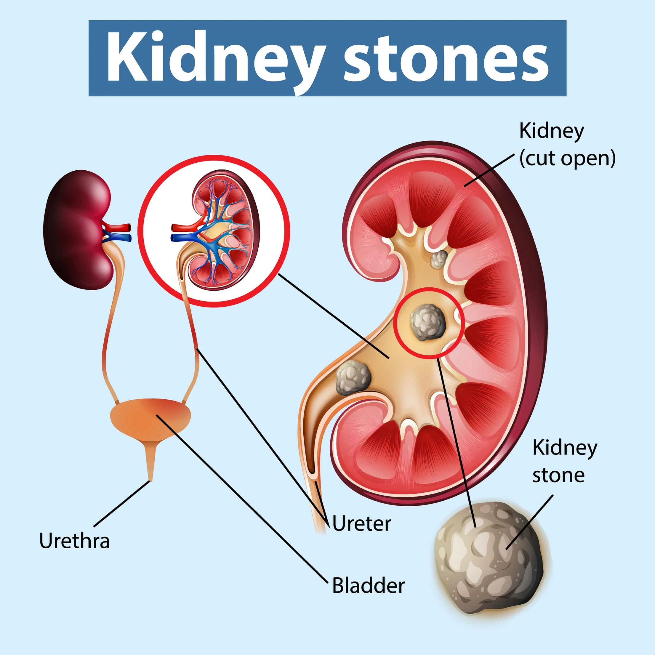 Precision Diagnosis for Kidney Stones — Salem Gopi Hospitals