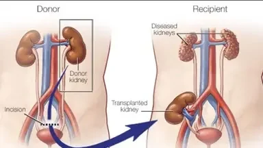 Pre & Post Kidney Transplant Guidance